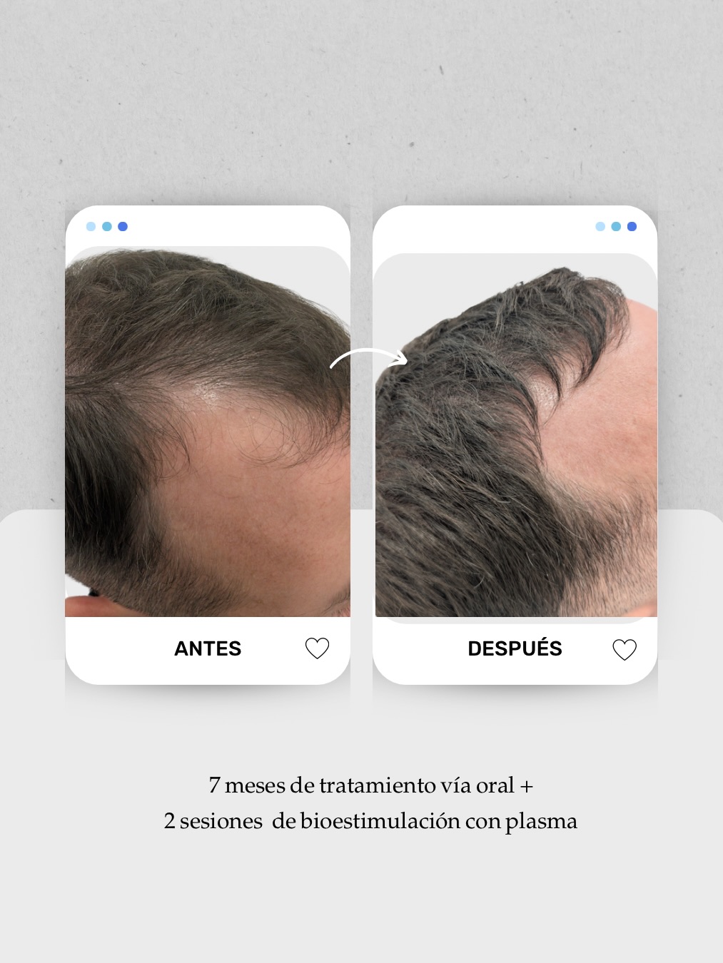 📊 Más del 50% de los hombres notan pérdida de densidad capilar antes de los 50 años.
En este caso trabajamos entradas y coronilla, dos zonas donde suele apreciarse una disminución de cobertura del cabello.
Tratamiento:
7 meses de tratamiento vía oral + 2 sesiones de bioestimulación con plasma 🧬
Cada alopecia es diferente, por eso el diagnóstico y el plan son siempre personalizados, según la causa y la fase del folículo.
👩🏻⚕️ Dra. Vanessa Márquez
Especialista en alopecia masculina · caída del cabello · medicina capilar
📍 Lanzarote y Las Palmas de Gran Canaria
📞 680 73 14 53 | 696 38 27 55