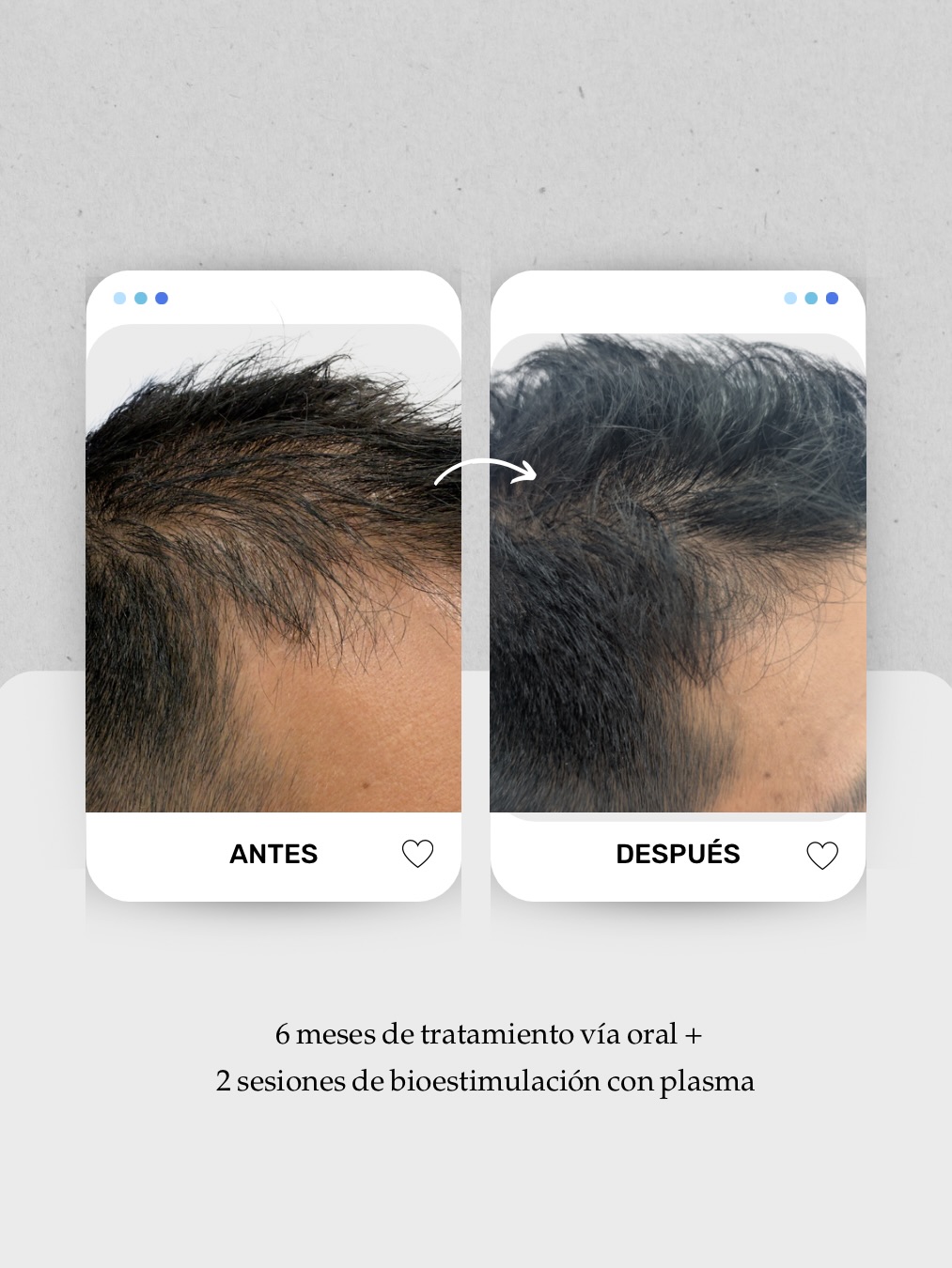 📈 Caso en evolución: entradas, coronilla y pérdida de densidad general.
En muchos casos de alopecia androgenética, el pelo no se cae de golpe: se va afinando poco a poco hasta que el cuero cabelludo empieza a verse más 👀
El tratamiento hasta ahora ha sido:
🧠 6 meses de tratamiento vía oral
🧬 2 sesiones de bioestimulación con plasma
El objetivo no es solo recuperar densidad, sino también mejorar la calidad del folículo y acompañar el mantenimiento del cabello a largo plazo ✨
Si crees que esto le puede estar pasando a alguien, compártele este caso 📲
Y si te pasa algo similar, te espero en consulta.
👩🏻⚕️ Dra. Vanessa Márquez
Medicina capilar · Alopecia · Caída del cabello
📍 Consulta capilar en Canarias
Lanzarote: 680 73 14 53
Las Palmas de Gran Canaria: 696 38 27 55
#alopecialanzarote #calviciemasculina #sininjertocapilar #